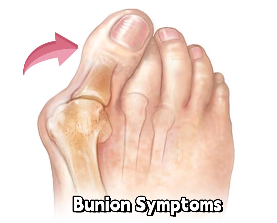 Can combat boots cause bunions Professional Military Boots