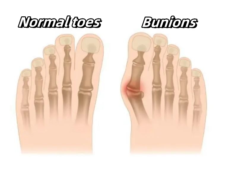 healthy toes and bunions