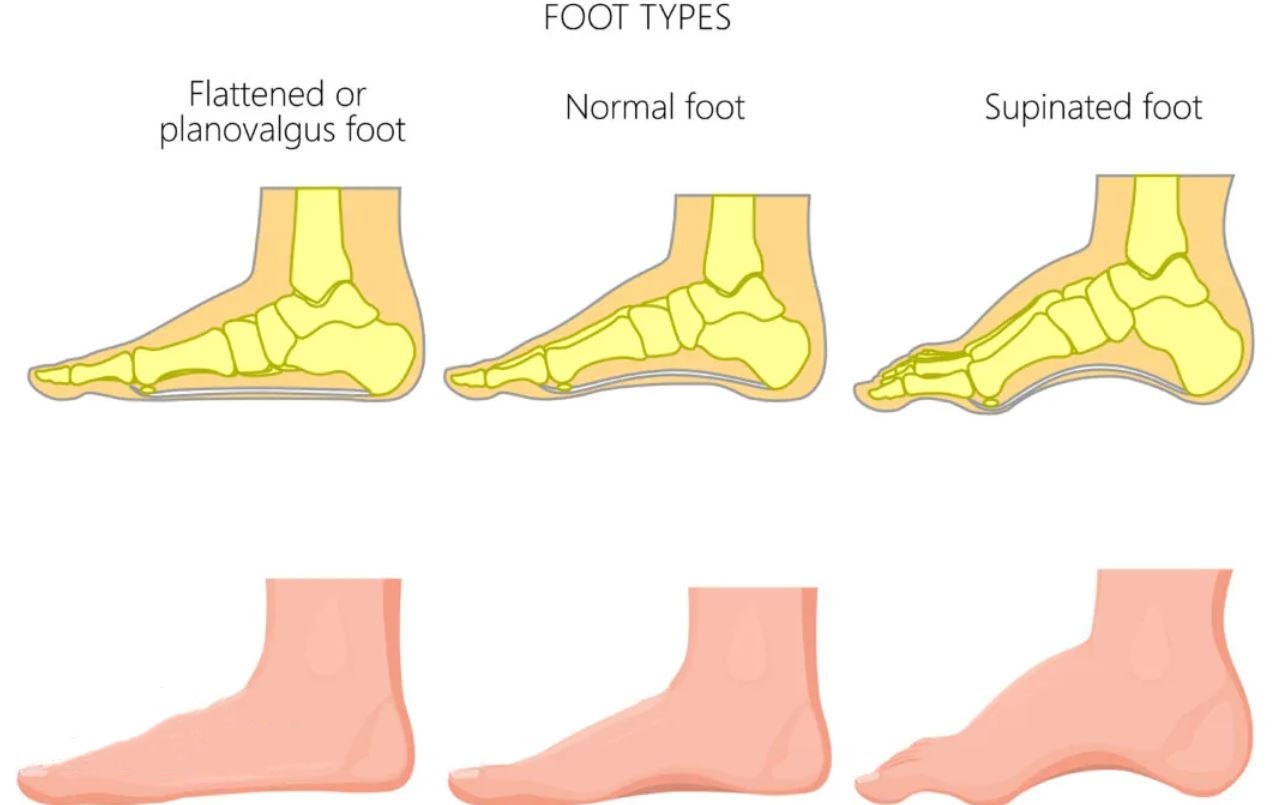 Experts Reveal What's Behind Flat Feet Aggravated By Military Service