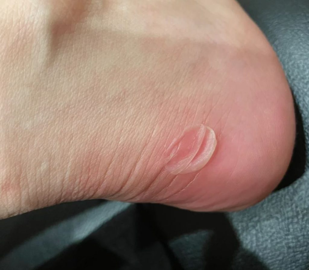 How to Prevent and Treat Blisters