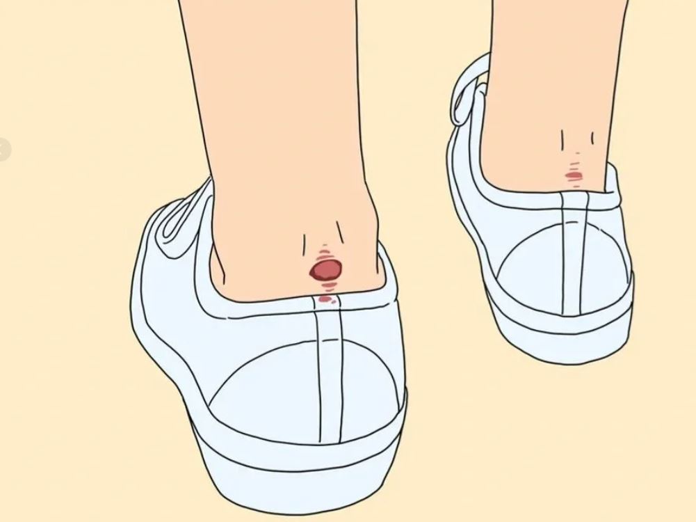 to Prevent and Treat Blisters